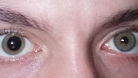 Exemple de pupilles asymétriques, ce que l'on appelle une anisocorie. (Crédits Tair1978 via wikipedia)