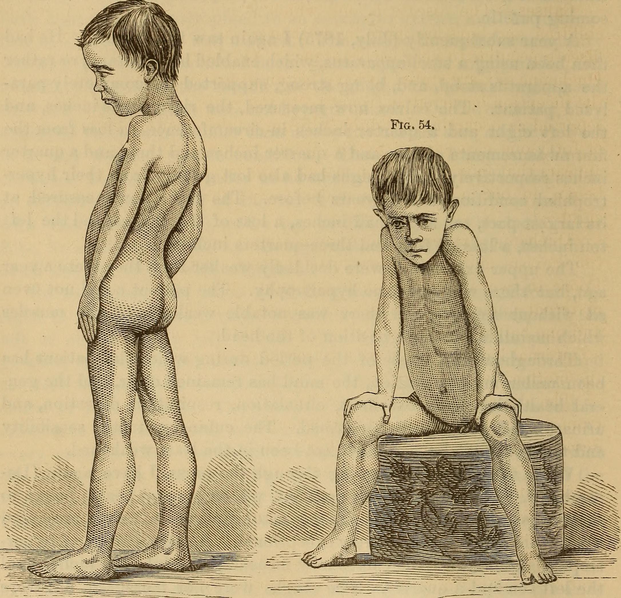 Illustration d'un enfant atteint de la myopathie de Duchenne (wikipedia)