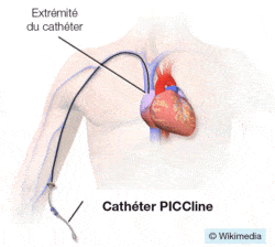 PICC Line (https://commons.wikimedia.org/wiki/File:Blausen_0193_Catheter_PICC.png, Blausen Medical Communications, Inc., Creative Commons)