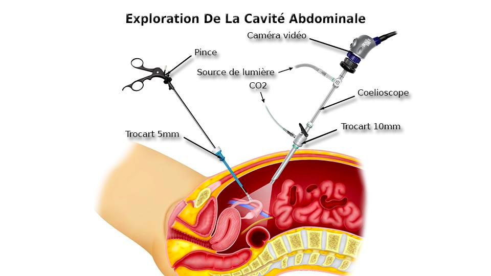 Schéma de cœlioscopie (https://www.drvelemir.fr/coelioscopie/). Généralement il y a deux ou trois trocarts en plus du trocart à optique. Ici c'est une opération gynécologique car la pince maintient la trompe de Fallope qui relie l'utérus à l'ovaire, mais le principe est le même pour une chirurgie digestive.