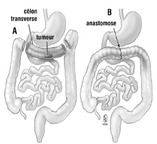 Résection - anastomose (https://hopitalmontfort.com/sites/default/files/PDF/resection_intestinalle.pdf). Ici c'est une résection-anastomose du côlon transverse, il faut imaginer la même chose avec l'intestin grêle.